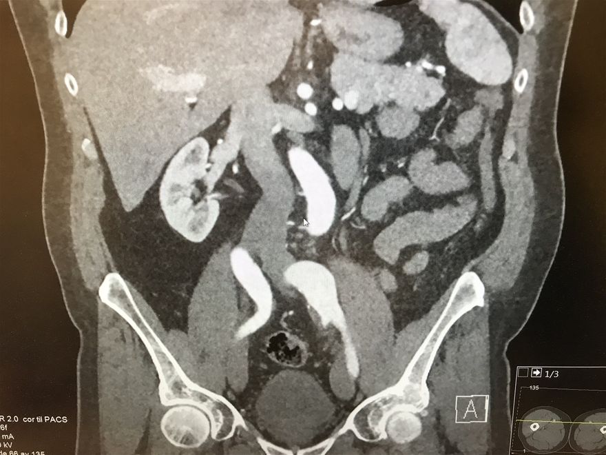 CT-abdomen med kontrast og påvist slynget og utvidet abdominalaorta